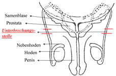 Darstellung Vasektomie